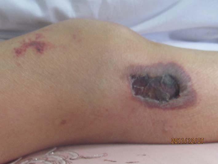 Gđa Huang Meiling i ožiljak na nozi