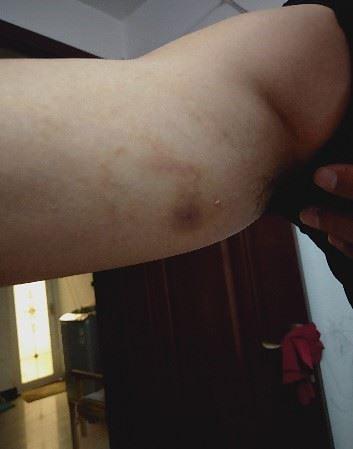 Modrice na tijelu g. Lija od policijskog nasilja