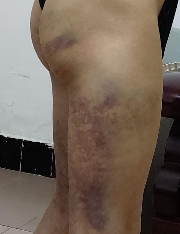 G. Deng prekriven modricama nakon što ga je policija pretukla.