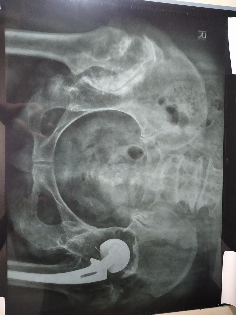 Rentgenski snimak karlice IR 21.03.2023